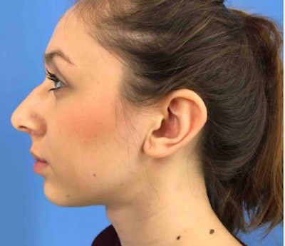 Rhinoplasty before and after - before