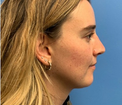Rhinoplasty before and after - after