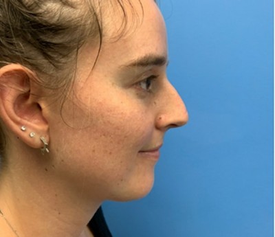 Rhinoplasty before and after - before