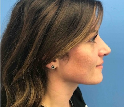 Rhinoplasty before and after - after