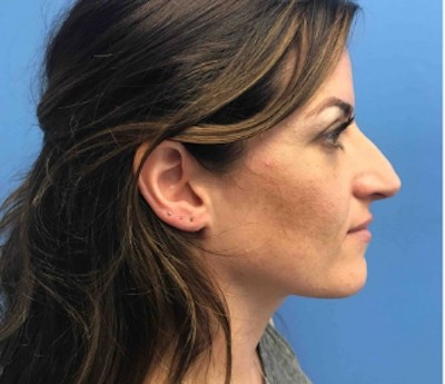 Rhinoplasty before and after - before