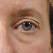 Blepharoplasty before and after - after