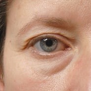 Blepharoplasty before and after - before
