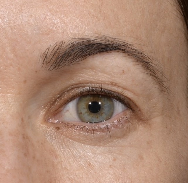 Blepharoplasty before and after - after