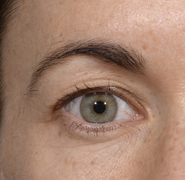 Blepharoplasty before and after - before