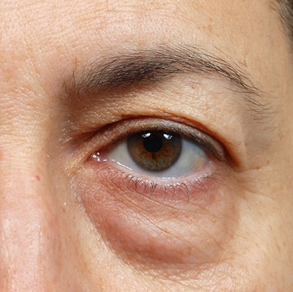 Blepharoplasty before and after - after