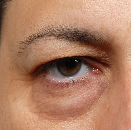 Blepharoplasty before and after - before