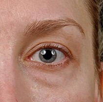 Blepharoplasty before and after - after