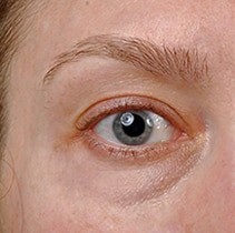 Blepharoplasty before and after - before