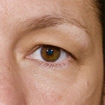 Blepharoplasty before and after - after