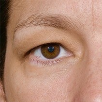 Blepharoplasty before and after - before