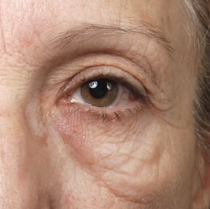 Blepharoplasty before and after - after