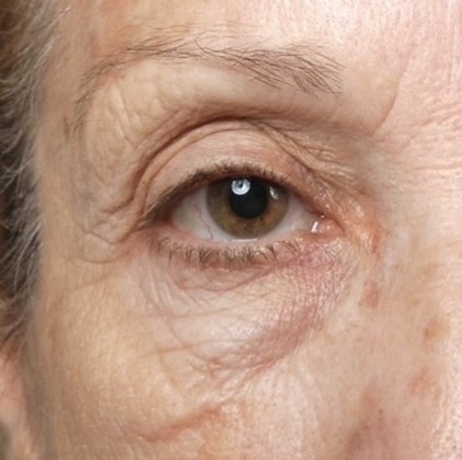Blepharoplasty before and after - before