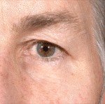 Blepharoplasty before and after - after