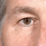 Blepharoplasty before and after - before