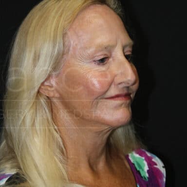 Procedure before and after - after