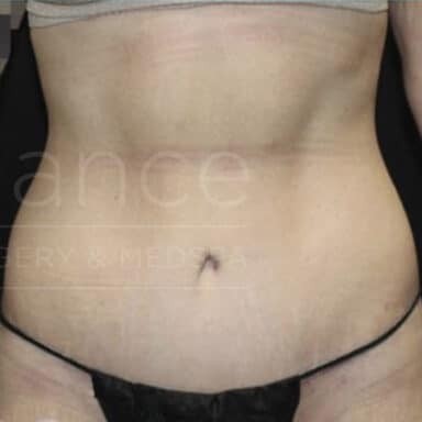 Procedure before and after - after