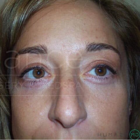 Blepharoplasty before and after - after