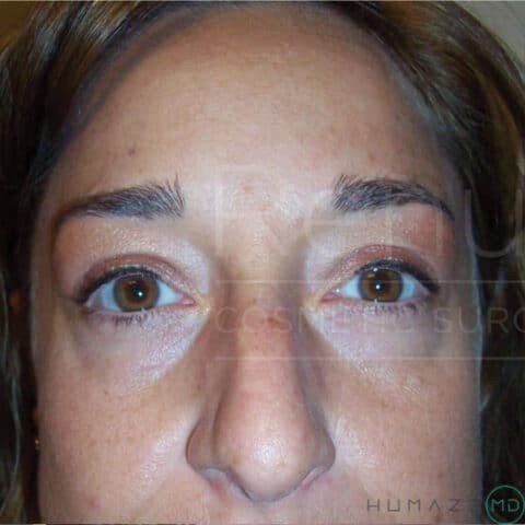 Blepharoplasty before and after - before