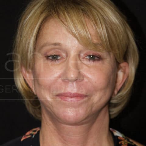 Blepharoplasty before and after - after