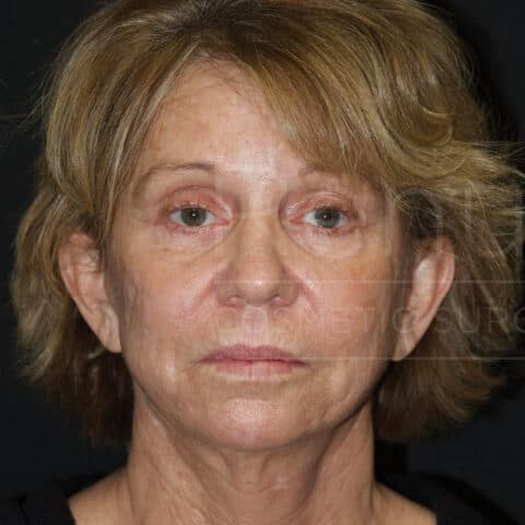 Blepharoplasty before and after - before
