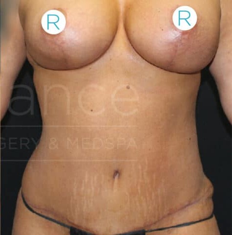 Mommy Makeover before and after - after