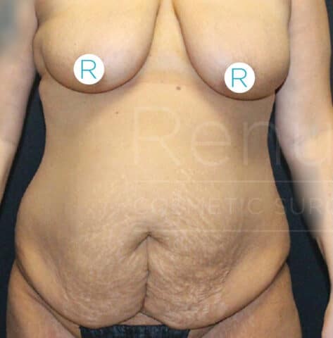Mommy Makeover before and after - before