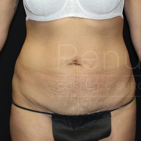 Mommy Makeover before and after - before