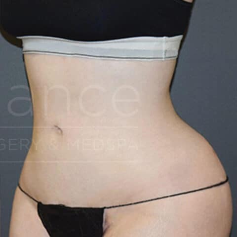 Vaser Liposuction before and after - after