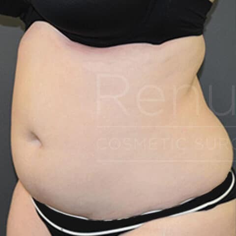 Vaser Liposuction before and after - before