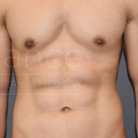Vaser Liposuction before and after - after