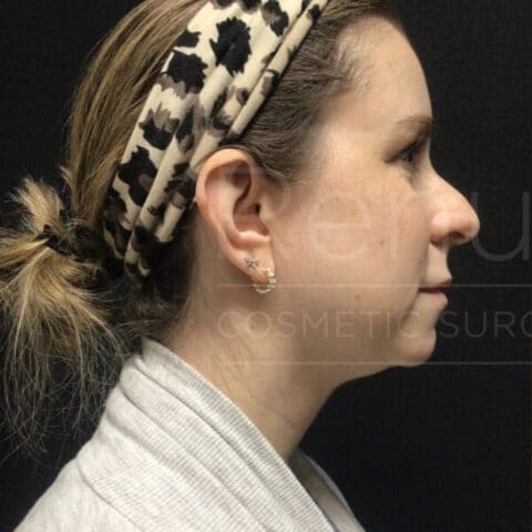Renuvion before and after - before