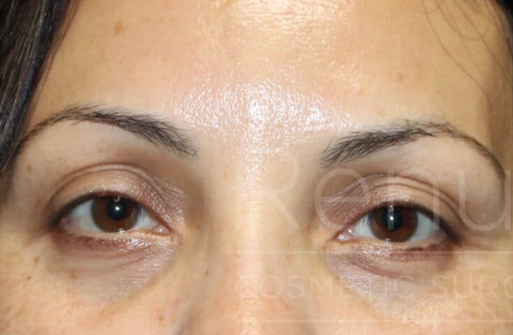 Blepharoplasty before and after - before