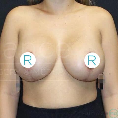 Breast Lift before and after - after