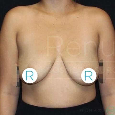 Breast Lift before and after - before