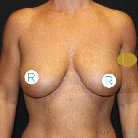 Breast Lift before and after - before