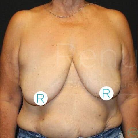 Breast Lift before and after - before