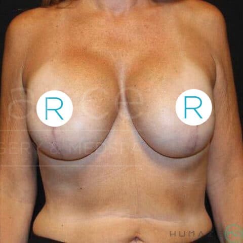 Breast Lift before and after - after