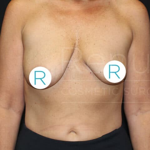 Breast Lift before and after - before