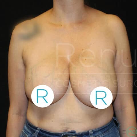 Breast Reduction before and after - before