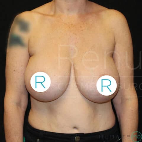 Breast Reduction before and after - before