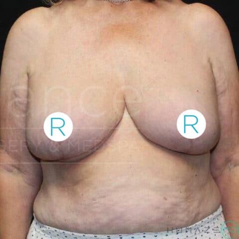 Breast Lift before and after - after