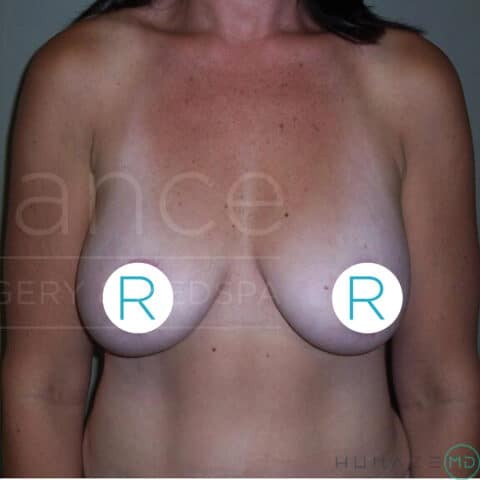 Breast Lift before and after - after