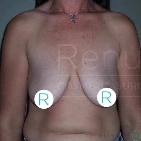 Breast Lift before and after - before