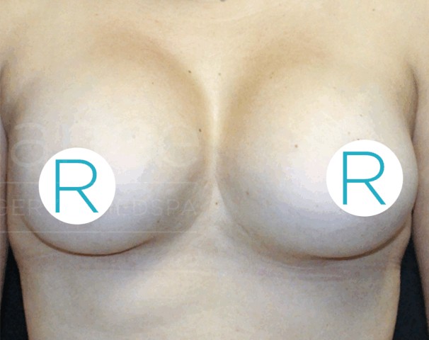 Breast Implant Revision before and after - after