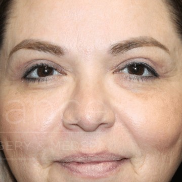 Blepharoplasty before and after - after