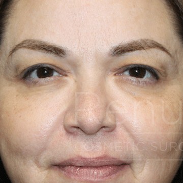 Blepharoplasty before and after - before