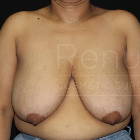 Breast Reduction before and after - before