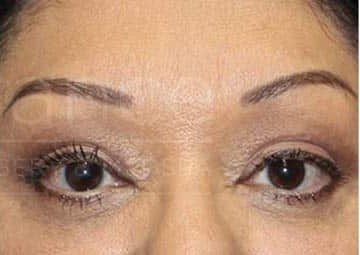 Blepharoplasty before and after - after