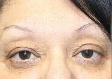 Blepharoplasty before and after - before